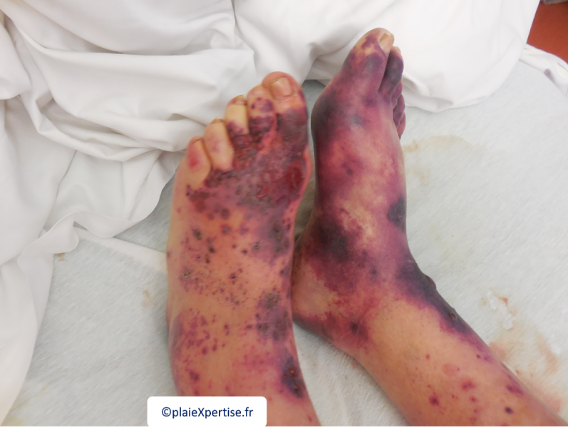 Fichier:Vascularite10.png
