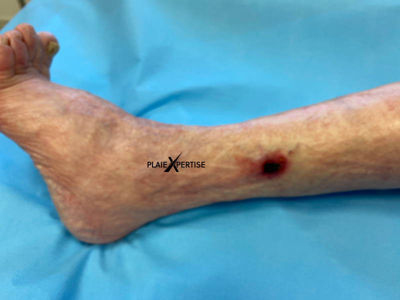 Fichier:Angiodermite typique43.png