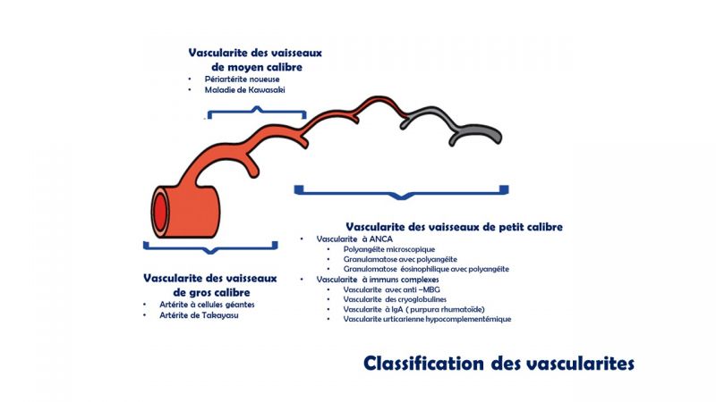 Fichier:Classification des vascularites 1.jpg