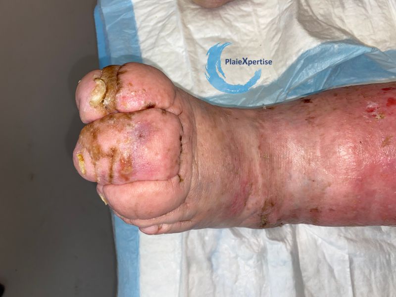 Fichier:Lymphoedème43.jpg