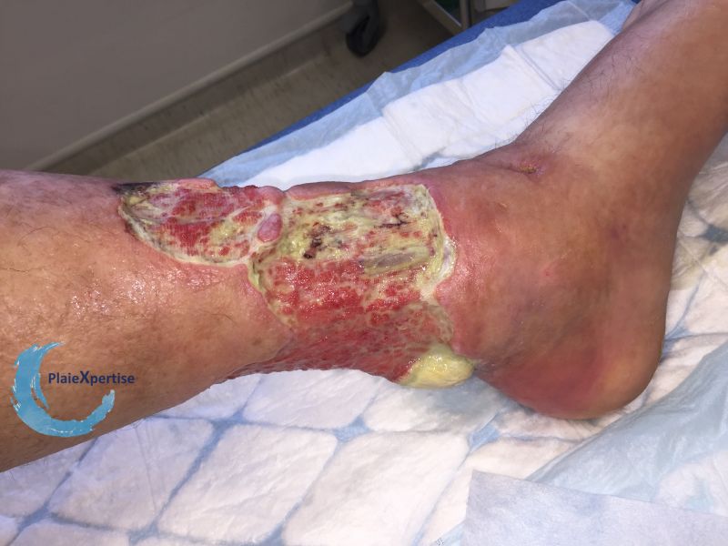 Fichier:Tendon-Voussure18.jpg