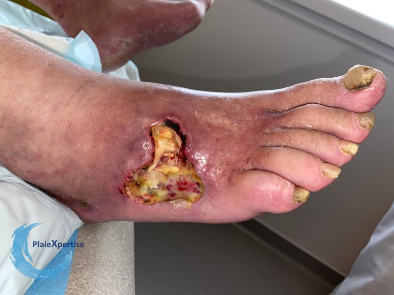 Fichier:Tendon nécrotique humide73.jpg