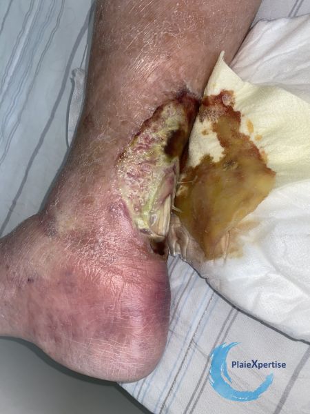 Fichier:Tendon nécrotique humide74.jpg