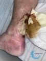 Tendon nécrotique humide74.jpg