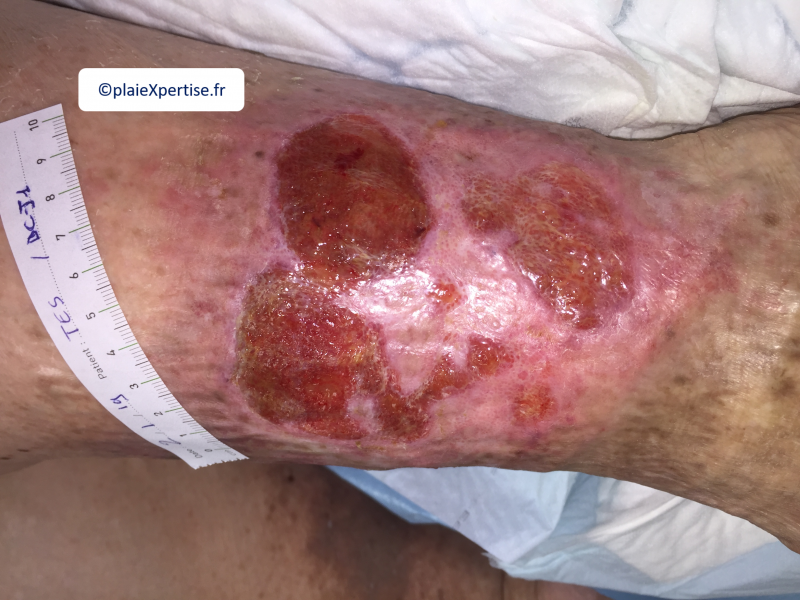 Fichier:Erosion ponctiforme plus 5 mm4.png