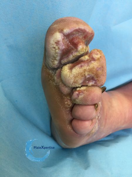 Fichier:Lymphoedème51.jpg