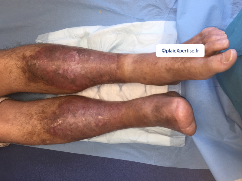 Fichier:Nécrobiose lipoïdique4.png