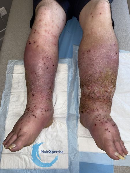 Fichier:Grosses jambes suintantes47.jpg