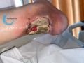 Tendon nécrotique humide56.jpg