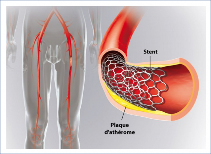 Fichier:Stent.png