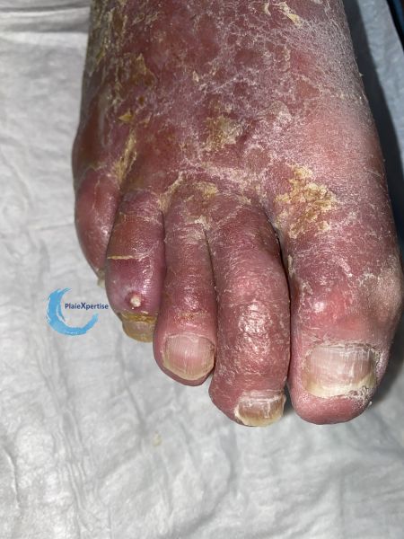 Fichier:Eczéma161.jpg