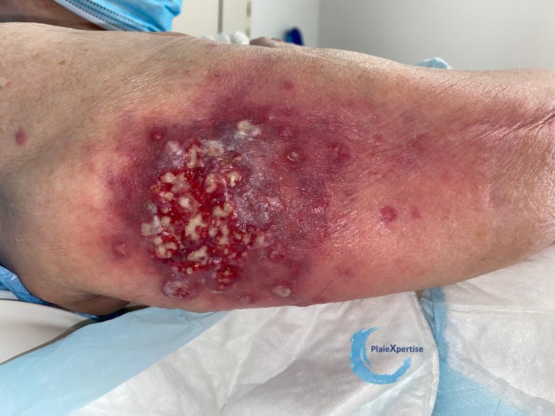Fichier:Pyoderma gangrenosum67.jpg