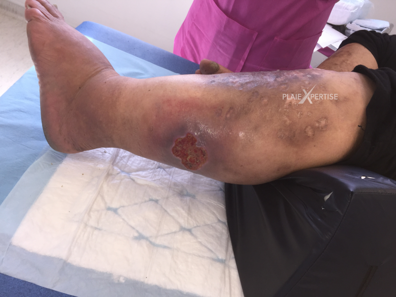 Fichier:Grosses jambes suintantes26.png