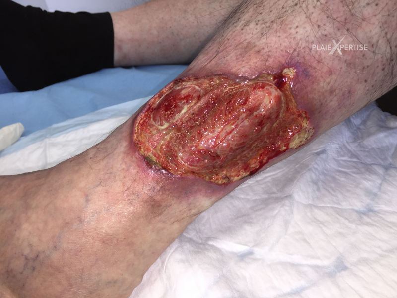 Fichier:Tendon-Voussure17.png