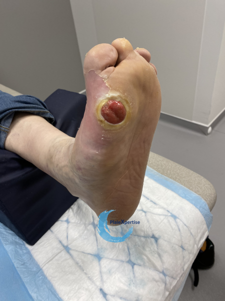 Fichier:Pied de Charcot5.png