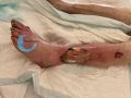 Tendon nécrotique humide58.jpg