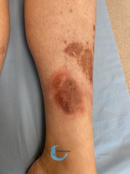 Fichier:Eczéma156.jpg