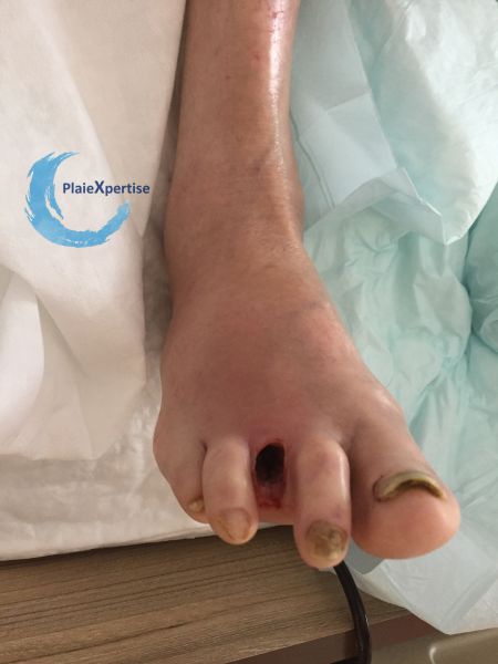 Fichier:Amputation27.jpg