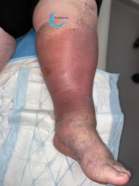 Fichier:Grosses jambes suintantes43.jpg