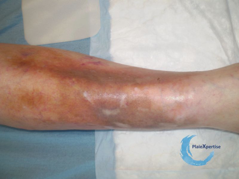 Fichier:Dermatoporose38.jpg
