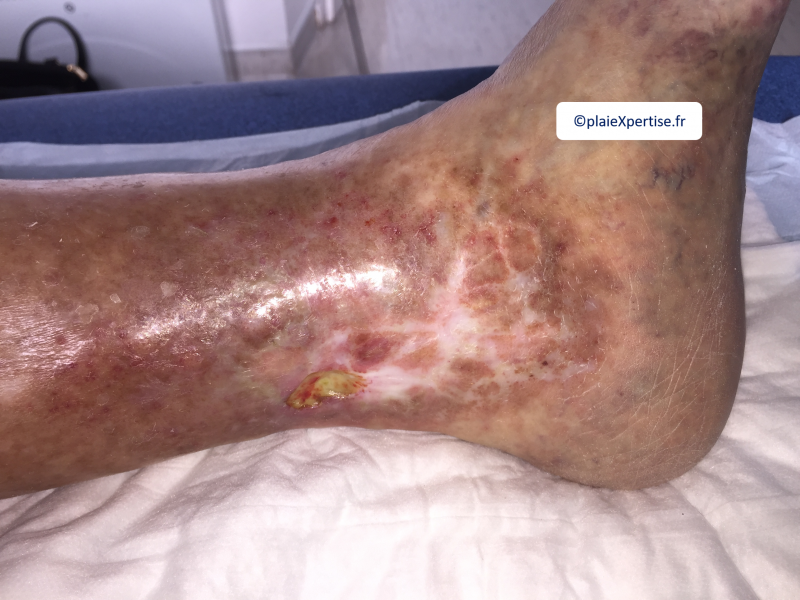 Fichier:Dermiteocre16.png