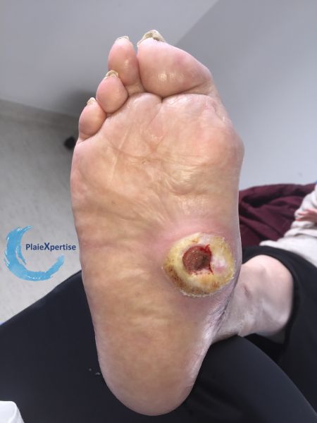 Fichier:Pied de Charcot32.jpg