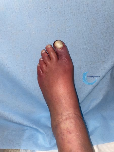 Fichier:Erythrocyanose30.jpg