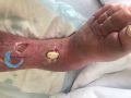 Tendon nécrotique humide54.jpg