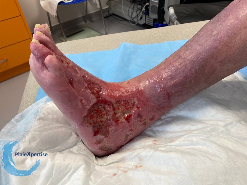 Fichier:Ulcère veineux36.jpg