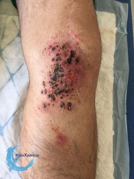 Fichier:Pyoderma gangrenosum53.jpg