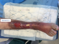 Tendon normal15.png