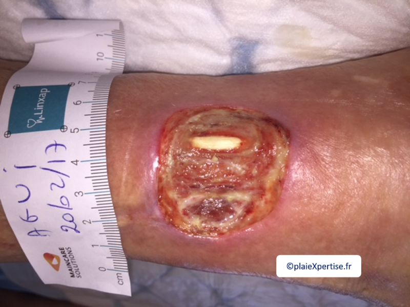 Fichier:Tendon normal3.png