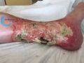 Tendon nécrotique humide48.jpg