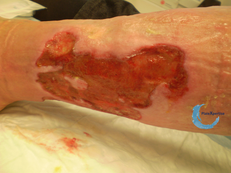 Fichier:Tissu de granulation inflammatoire35.png