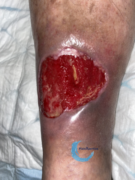 Fichier:Tissu de granulation normal37.png