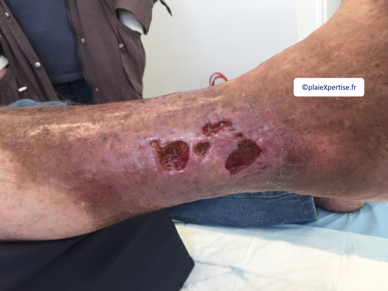 Fichier:Dermiteocre11.png