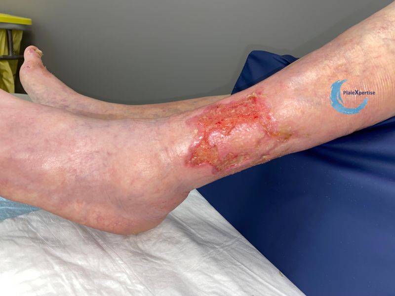 Fichier:Epidermisation 20.jpg
