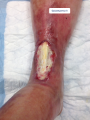Tendon normal12.png