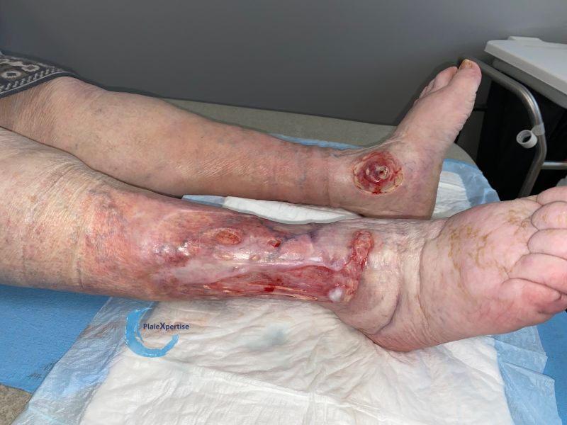 Fichier:Tendon normal51.jpg