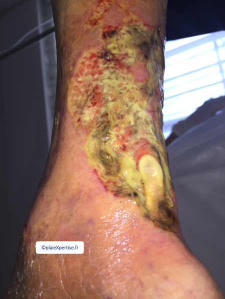 Fichier:Tendon nécrotique humide14.png