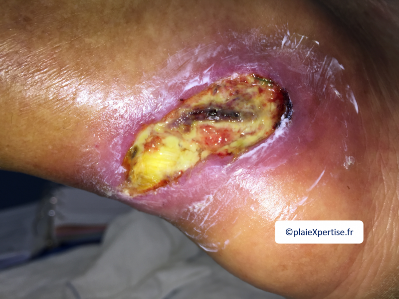 Fichier:Tendon nécrotique humide25.png