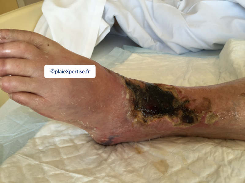 Fichier:Tendon nécrotique sec8.png