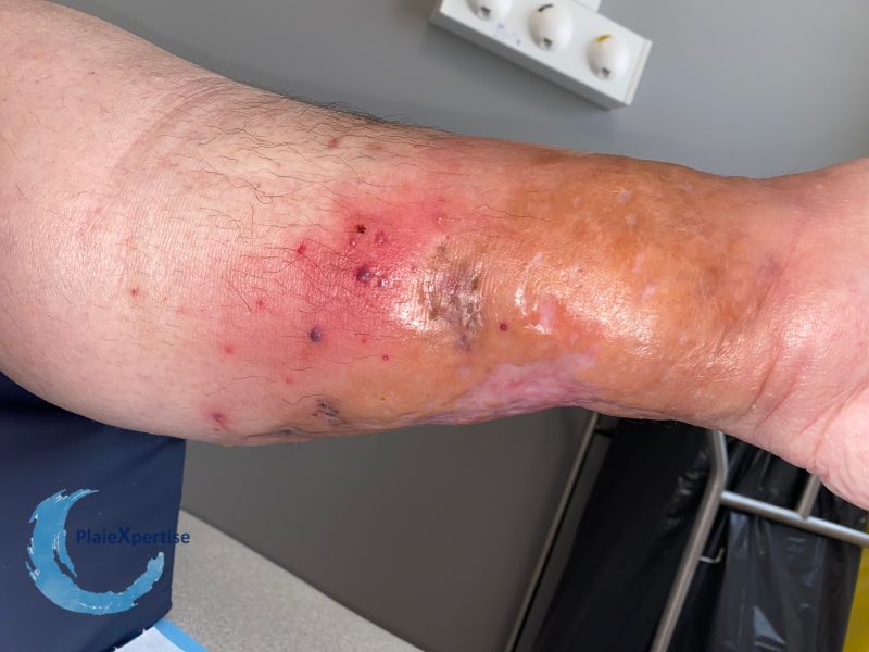 Fichier:Pyoderma gangrenosum54.jpg