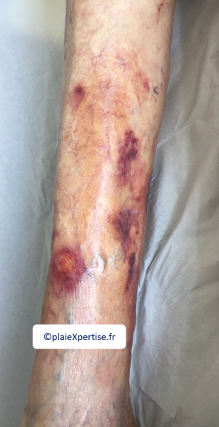 Fichier:Dermatoporose12.png