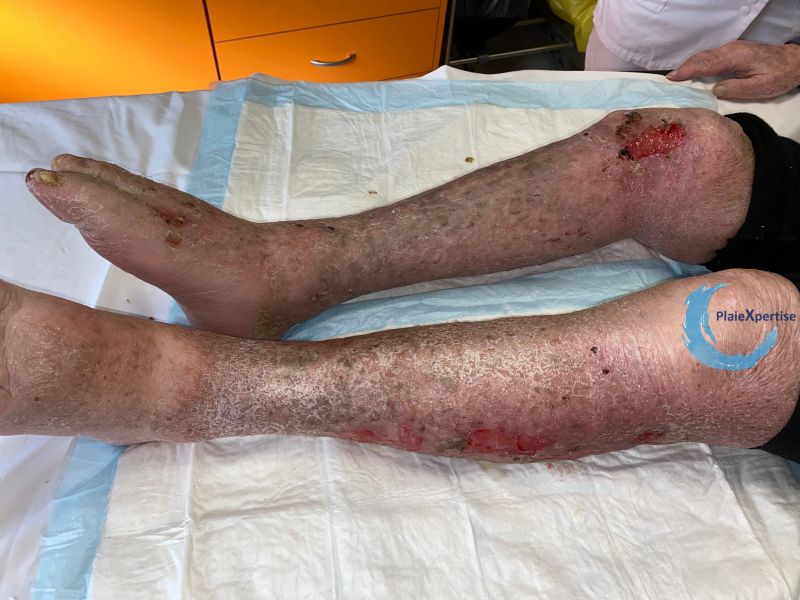 Fichier:Eczéma craquelé23.jpg