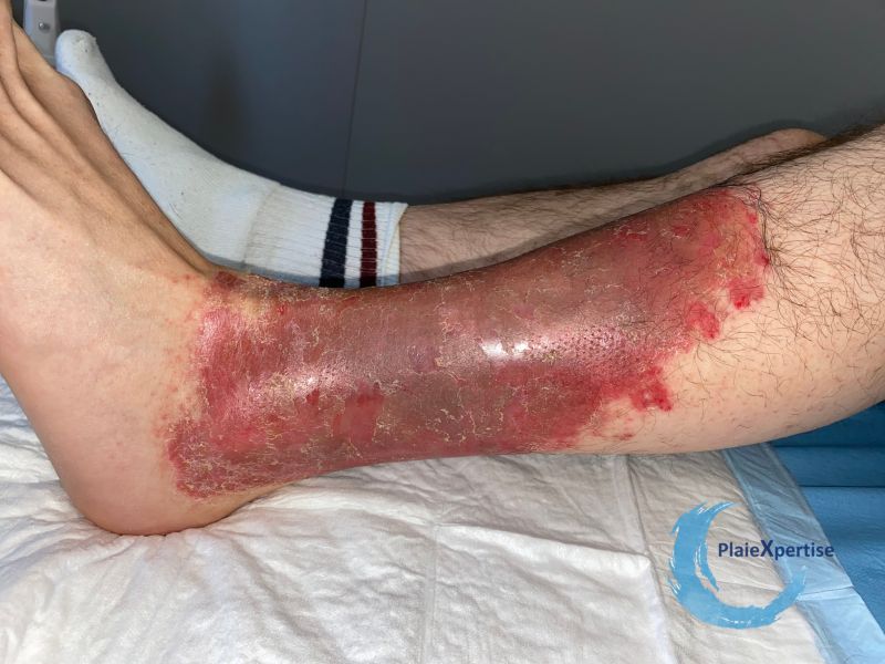 Fichier:Eczéma111.jpg