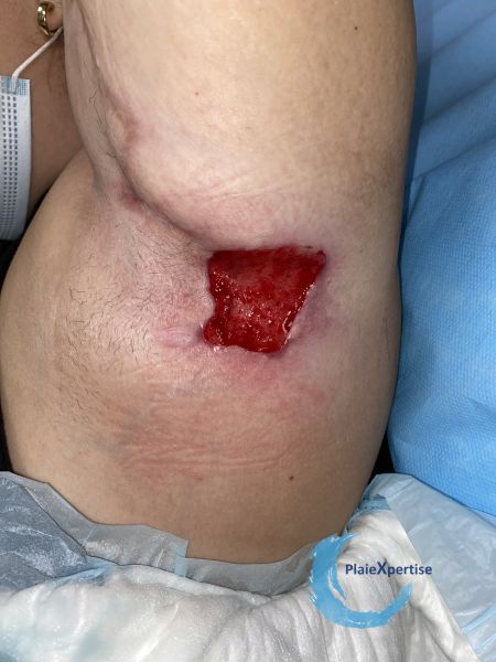 Fichier:Tissu de granulation normal59.jpg