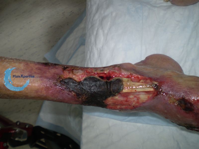 Fichier:Tendon nécrotique sec13.jpg