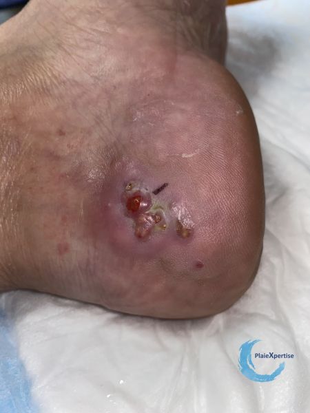 Fichier:Calcifications40.jpg