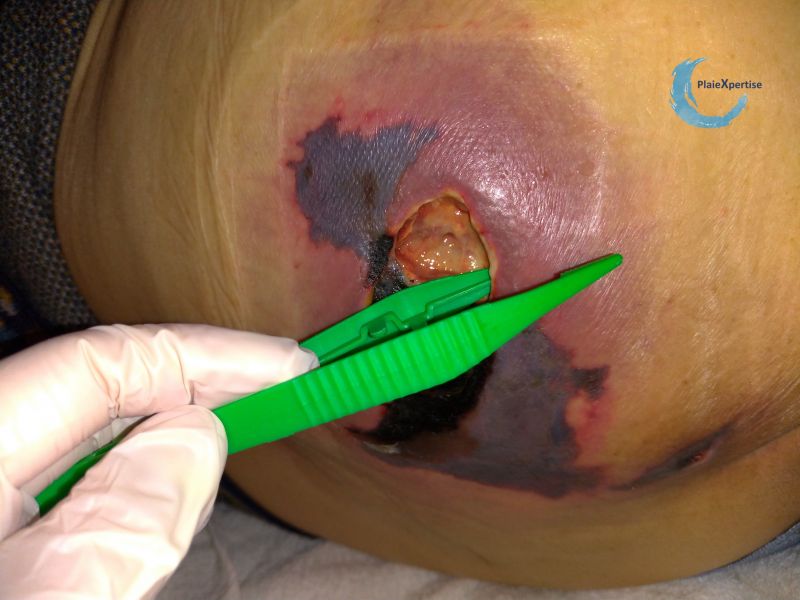 Fichier:Calciphylaxie20.jpg